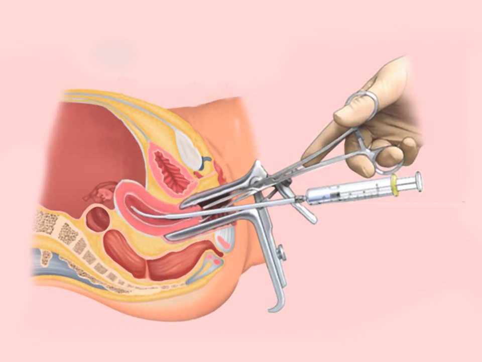 iui-treatment-in-jabalpur